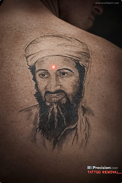 Precision Laser Tattoo Removal